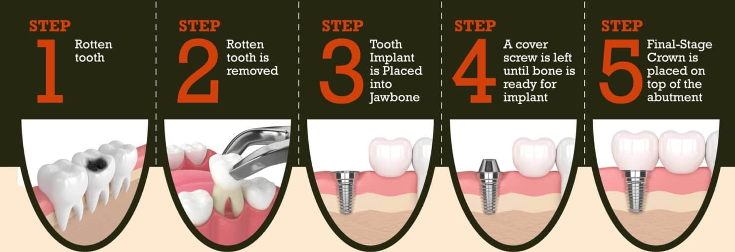 Dental Implant Basic Procedure
